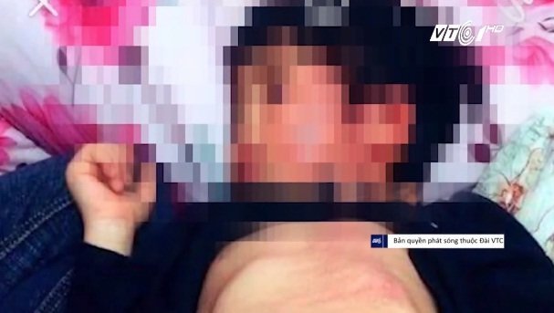 Bé gái bị đánh bầm tím toàn thân khi đi học: Do cô giáo hay do bạn?