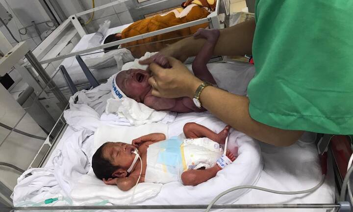 Em bé sinh non 1,7kg, tăng 'thần tốc' lên 5,3kg trong 3 tháng