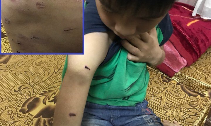 Bé trai học lớp 4 bị bố dùng dây điện đánh dã man