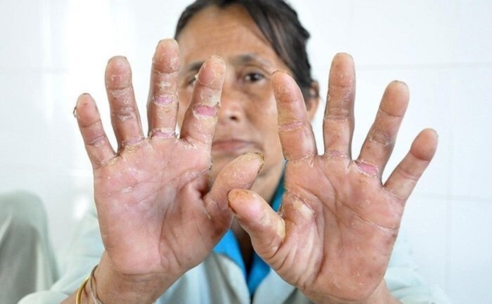 Quảng Ngãi: Nhiều người tái mắc 'bệnh lạ' cực kỳ nguy hiểm