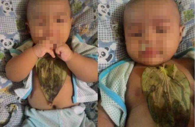 Trị sổ mũi bằng lá trầu, bé gái bị bỏng nặng vùng ngực