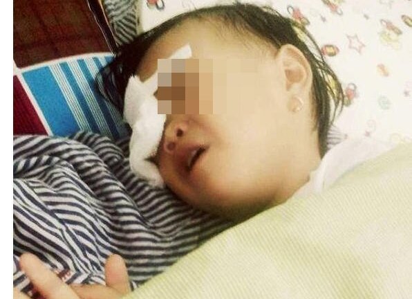 Bé gái 2 tuổi ở Nghệ An bị gà mổ mù mắt