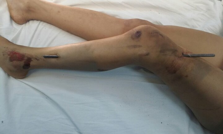 Những ca bệnh khó tin nhất năm 2017: Người chết bỗng thức dậy, 100 khối u giày vò, bào thai lạc lên lá lách