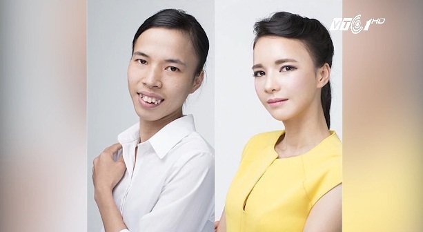 Cô gái Bắc Giang hé lộ hành trình du lịch thẩm mỹ gian nan