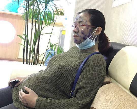 Thai nhi chào đời khỏe mạnh dù mẹ mắc thủy đậu ở tuần thứ 9