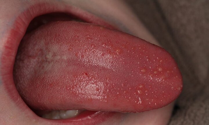 Có thể đắp lá đinh lăng chữa bệnh sùi mào gà?