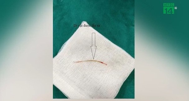 Video: Cứu sống bệnh nhân 72 tuổi bị xương cá đâm thủng ruột