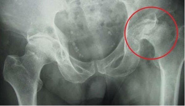 Hoại tử khớp háng khi tiêm corticoid chữa ngứa đầu
