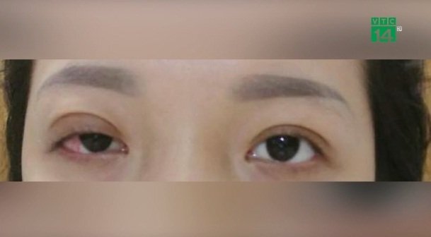 Cô gái vĩnh viễn không thể nhắm mắt sau khi cắt mí làm đẹp