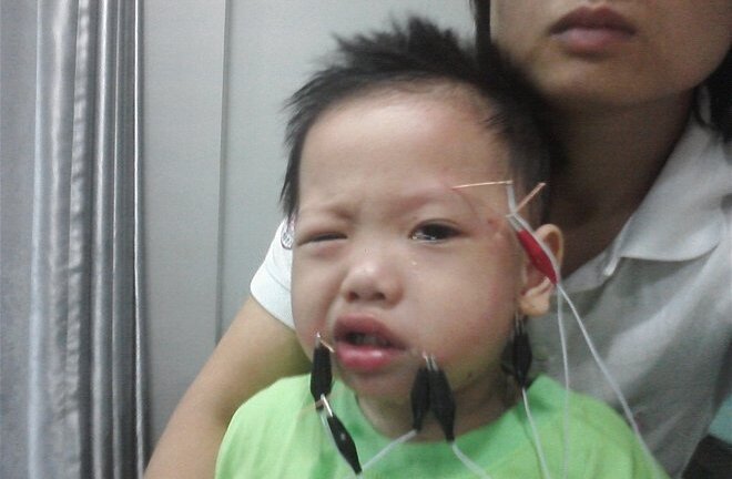 Trời lạnh, nhiều trẻ em bị méo miệng, lệch mặt