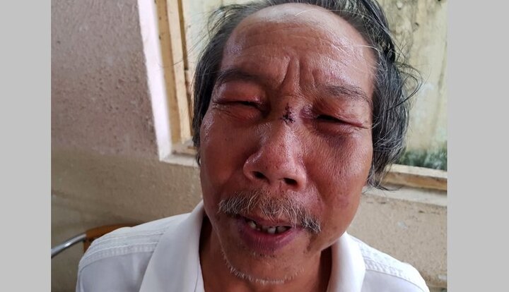 Lời kể của gia đình cụ ông bị bảo vệ chung cư đánh gãy sống mũi ở TP.HCM