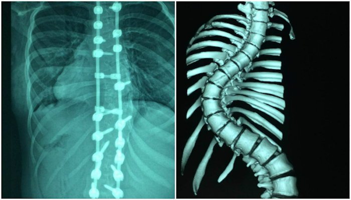 Thiếu nữ cao thêm 7 cm sau khi nắn cột sống từ vẹo thành thẳng