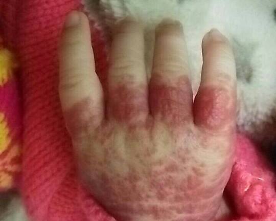 Vừa sinh ra, bé gái đã mang vết bớt đỏ phủ cả cánh tay
