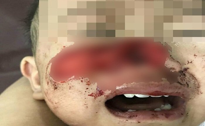 Xót xa bé trai 1 tuổi bị chó nhà cắn rách mặt, mất mũi