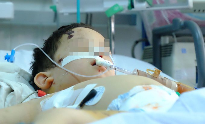 Đăk Lăk: Hai trẻ bị chó cắn nát mặt, đứt khí quản