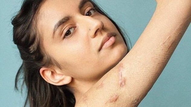 10 cô gái dũng cảm và câu chuyện vết sẹo đi theo cả cuộc đời