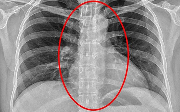 Gái mại dâm nuốt bao cao su để thủ tiêu bằng chứng