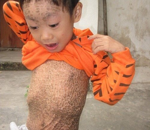 Xót xa bé trai mắc bệnh vảy cá bẩm sinh, toàn thân sần sùi, nứt nẻ