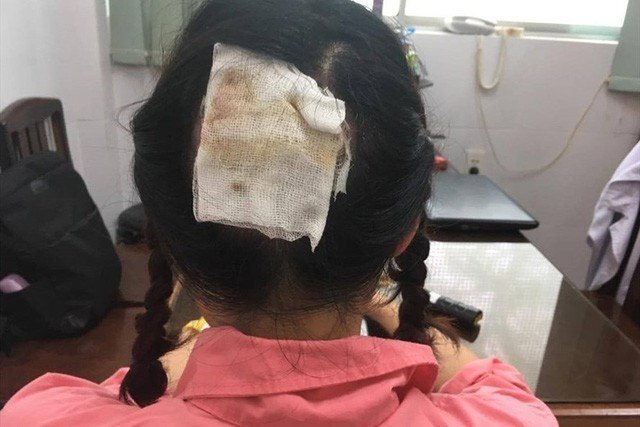 Uốn tóc đón Tết, người phụ nữ bị hoại tử da đầu vĩnh viễn, không thể phục hồi