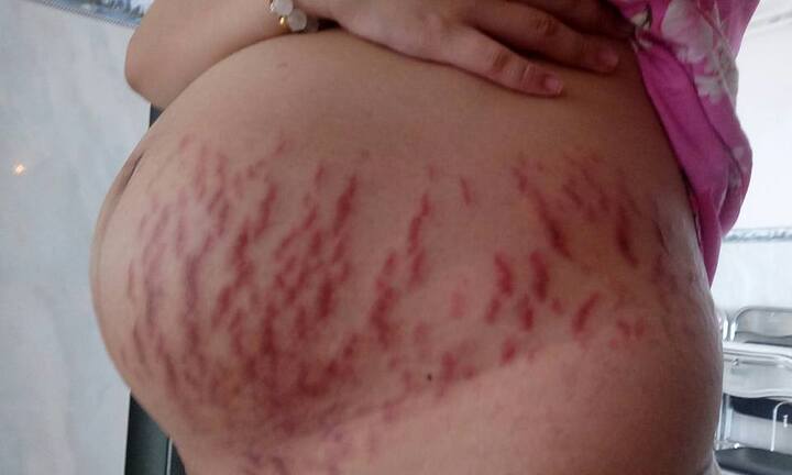 Tưởng chỉ rạn da, bà bầu tá hỏa khi bác sĩ thông báo bị ứ mật gan