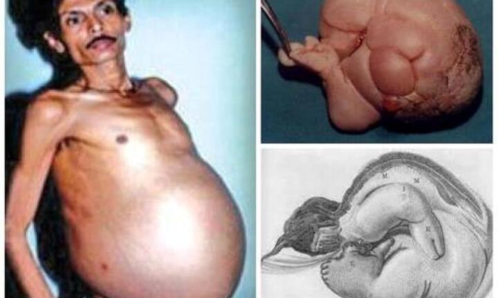 Chuyện lạ về người đàn ông mang thai suốt 36 năm ở Ấn Độ