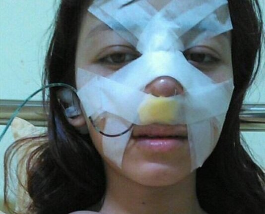 Cô gái chịu đau đớn 'chết đi sống lại' khi nâng mũi để sửa tướng