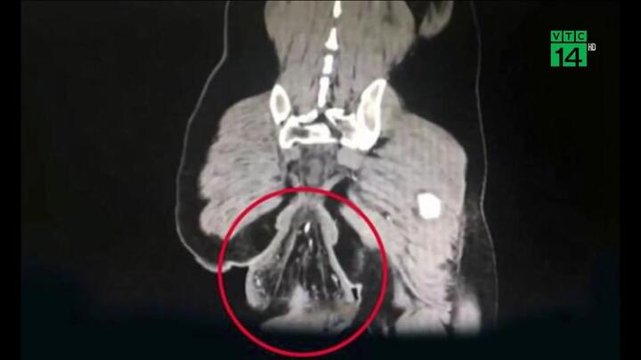 Mải chơi game khi đi vệ sinh, người đàn ông rơi cả ruột ra ngoài