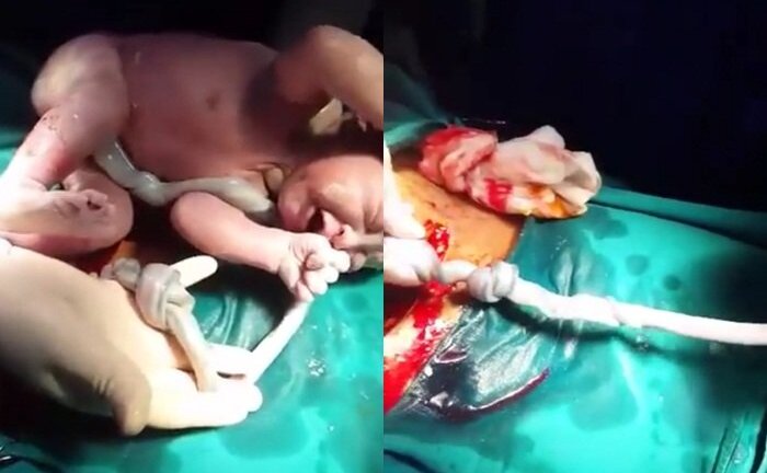 Video: Cận cảnh em bé bị dây rau thắt nút chào đời khỏe mạnh