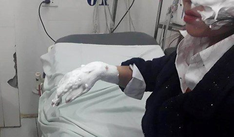 Bóng bay nổ trước cổng trường tiểu học ở Hà Nội, 3 sinh viên bỏng nặng