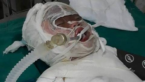 Rơi xuống hố vôi đang sôi sùng sục, bé gái hơn 2 tuổi bỏng nặng