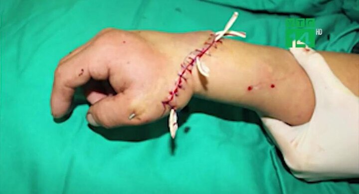 Video: Tự lái xe máy sau 3 tháng được nối bàn tay đứt lìa