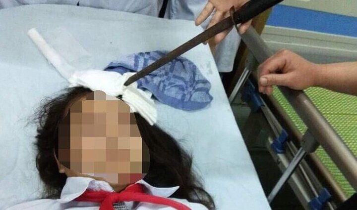 Nữ sinh bị bạn phi dao cắm thẳng vào trán