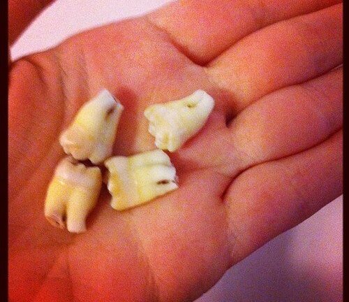 Video: Xem cận cảnh quá trình nhổ răng số 8