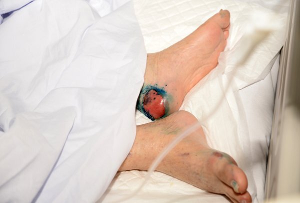 Cứ 32 giây lại có 1 người phải cắt cụt chân vì bệnh đái tháo đường