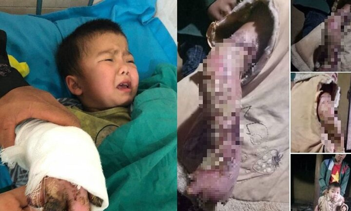 Đau lòng bé gái hoại tử cánh tay, ngón rụng hết vì ngã vào bếp lửa đỏ không được chữa