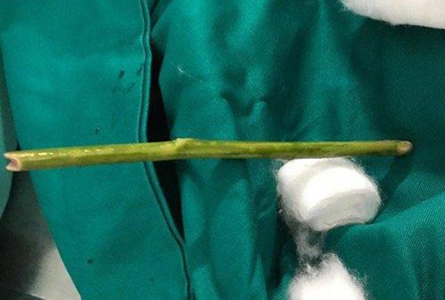 Chọc que nứa phá thai và những trường hợp phá thai kinh dị ở Việt Nam