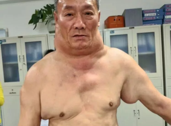 Uống rượu như nước, cơ thể biến dạng như ‘người khổng lồ xanh’