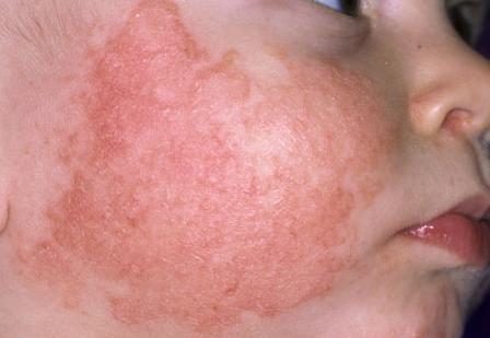 Làm gì khi trẻ bị dị ứng hải sản?