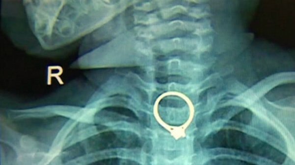 Ngủ quên, mẹ để con gái hóc nhẫn kim cương