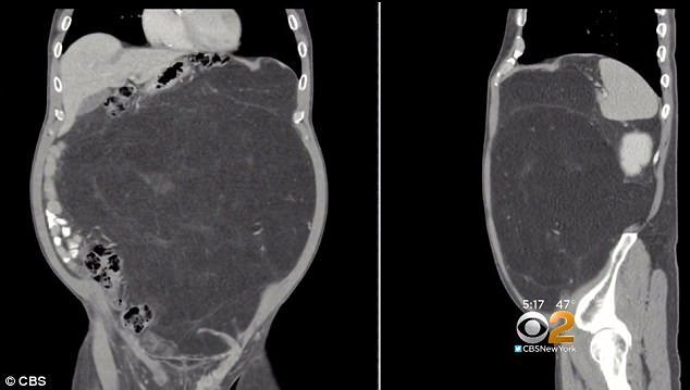 Mang khối u khổng lồ bao năm cứ ngỡ là bụng bia