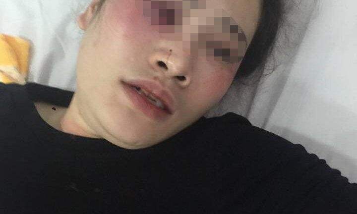 Tranh nhau đĩa bánh xèo, nam thanh niên đánh cô gái chảy máu mũi phải nhập viện