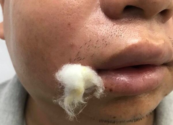 Cầu cứu bác sĩ sau 5 giờ cạy nốt mụn trên mặt