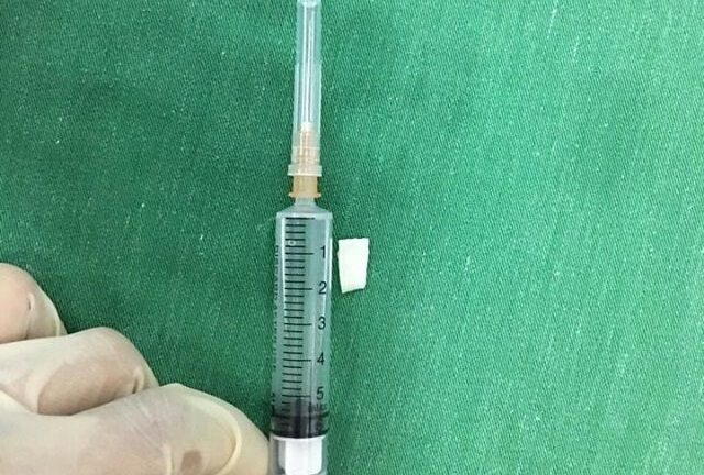 Mảnh cùi dừa găm vào thanh quản bệnh nhi suýt chết