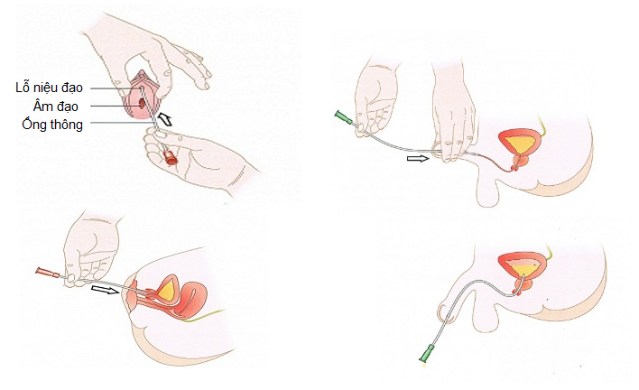 Bé gái 5 tuổi liên tục nhiễm khuẩn tiết niệu vì di chứng bệnh bàng quang thần kinh