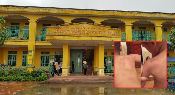 Bé trai 5 tuổi nghi bị giáo viên bạo hành dã man, phụ huynh không muốn làm to chuyện