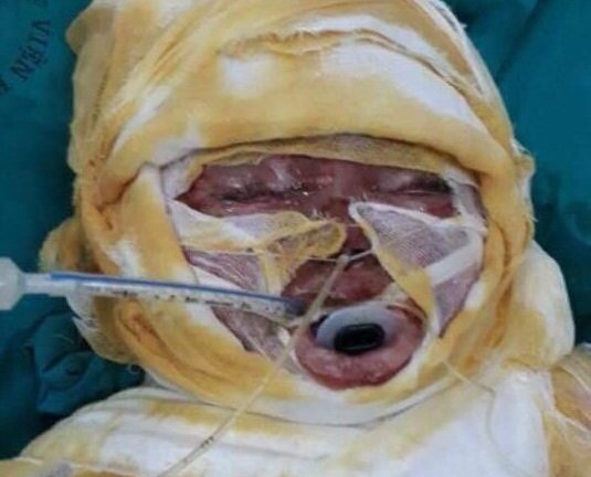 Xót thương bé gái 2 tuổi ngã vào nồi bỗng rượu bỏng nặng toàn thân