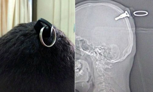 Ba giờ mổ rút chiếc chìa khóa xe máy cắm trong sọ chàng trai