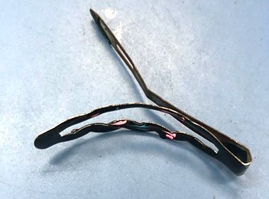 Bệnh nhi 12 tuổi thủng tá tràng vì nuốt phải chiếc kẹp tóc