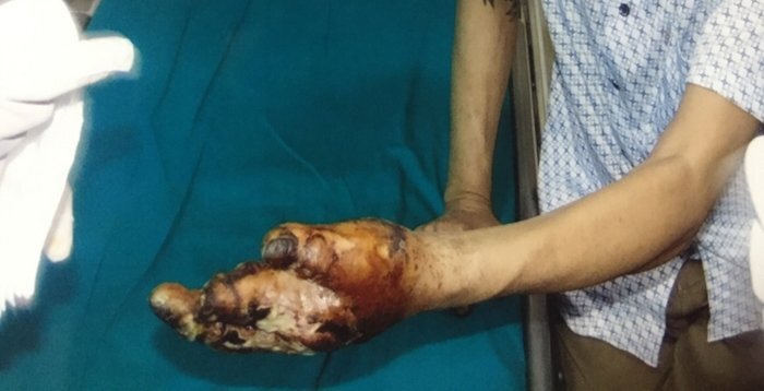 Da bong tróc, hoại tử bàn tay vì máy ép mía