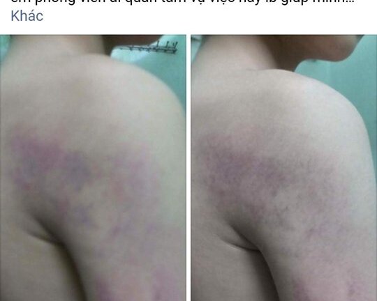 Nghi vấn học sinh lớp 1 Hà Nội bị cô giáo bạo hành thâm tím cánh tay